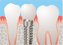 インプラント治療とは